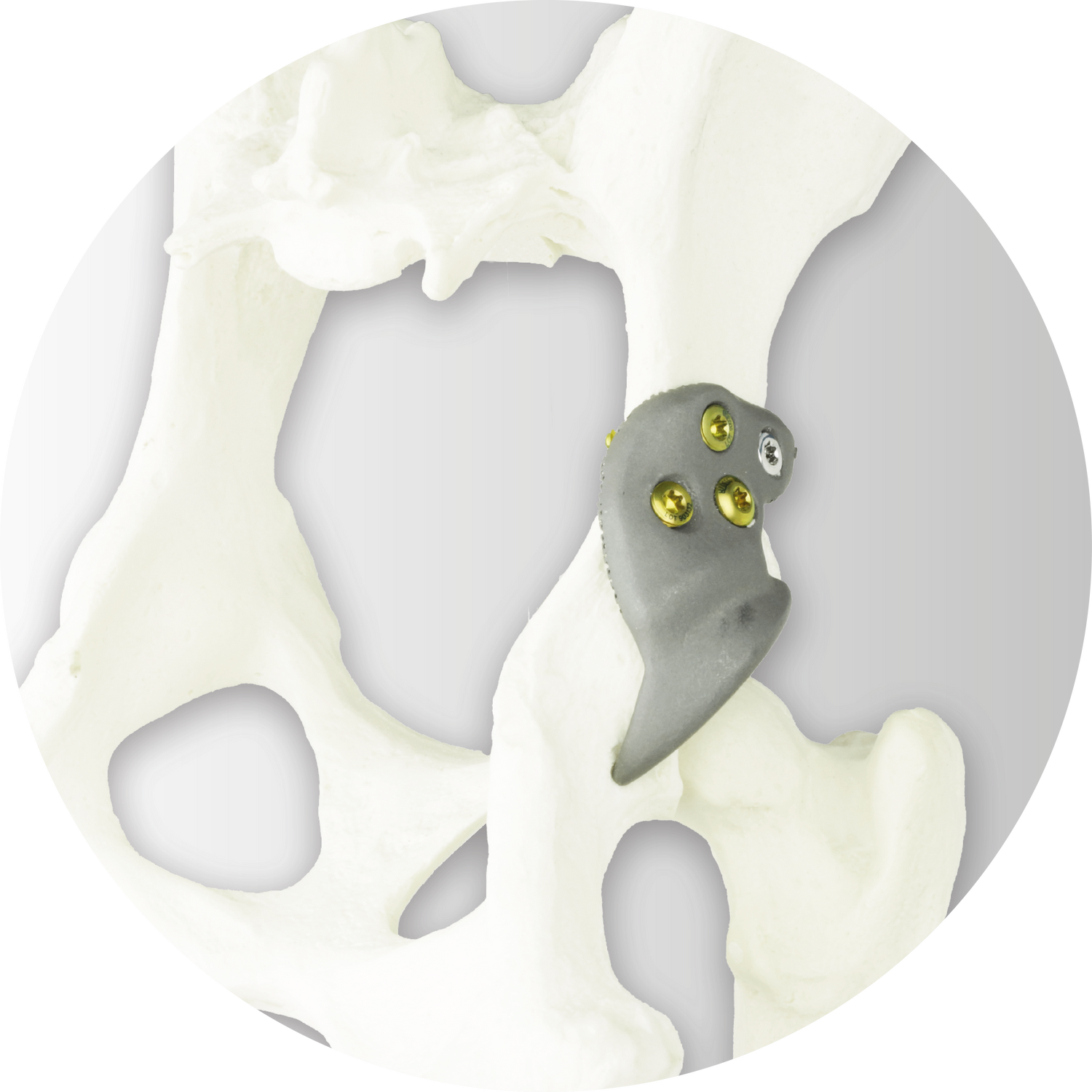 3D HIP Patient-Specific Implant, Titanium